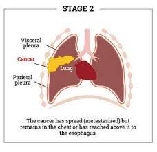 Despite this, pancreatic cancer is among the deadliest types of cancer, which is why it's extremely important to know and recogni. Mesothelioma What Are It S Causes Symptoms Prognosis Learn More