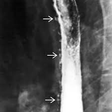 B from levine ms, woldenberg r, herlinger h, et al. Candida Esophagitis Radiology Key