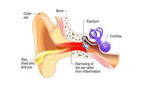 Image result for Acute Otitis Externa