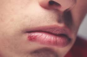 Here S How You Can Get Rid Of A Cold Sore Fast Health Essentials From Cleveland Clinic
