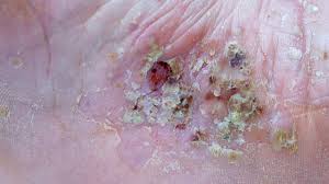 Image result for Pustular Psoriasis