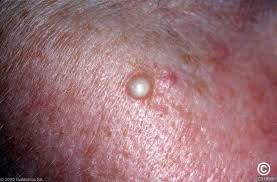 Image result for milium cyst on eyelid