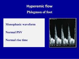 Doppler Ultrasound Of Lower Limb Arteries Lower Limb Ultrasound Vascular Ultrasound