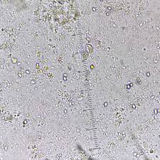 Image result for Stool Leukocytes
