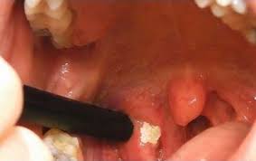 Apr 25, 2017 · how to remove teeth stains at home with natural ingredients: Tonsillectomy Outlander Anatomy