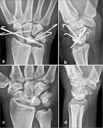 Image result for Scapholunate Dislocation