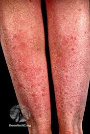Image result for polymorphous eruption