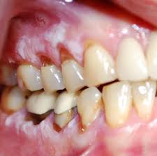 Image result for gums cancer symptoms