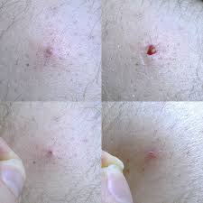 Lymph nodes are small glands that are located throughout the body most commonly, they're brought about by ingrown hairs, which happen when a hair's sharp point goes back into the skin, leading to an irritated bump. Ingrown Hair Wikipedia