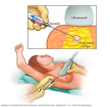 If you check more often, you are likely. Breast Cysts Diagnosis And Treatment Mayo Clinic
