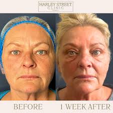 Upper Blepharoplasty Success Story