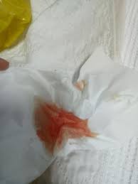 Batuk berdarah atau di dalam dunia medis sering disebut dengan hemoptisis adalah suatu kondisi ketika seseorang mengalami batuk yang disertai dengan darah. 30 Gambar Batuk Berdarah Di Tangan Terbaru Riwayat Gallery