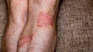 Image result for allergy rash on the legs