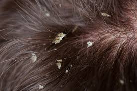 Image result for lice vs dandruff