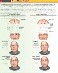 Often retain the ability to blink with both. Types Of Facial Paralysis Peripheral Vs Central Lesions Facial Grepmed
