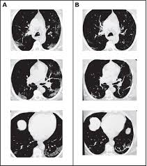 May increase to 8 mg/kg q4weeks based on clinical response. Subcutaneous Tocilizumab Treatment In Patients With Severe Covid 19 Related Cytokine Release Syndrome An Observational Cohort Study Eclinicalmedicine