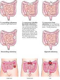 Types Of Colostomies Surgical Nursing Nerdy Nurse Nursing Mnemonics