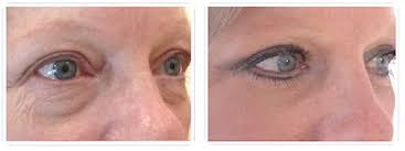 Premier soin ciblé pour moins de rides et plus d'éclat.sa concentration exceptionnelle en. Blepharoplastie Chirurgie Esthetique Des Paupieres A Paris