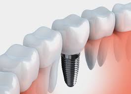 Join millions of seniors across the nation & start saving Free Dental Implant Forestside Dental Practice Facebook