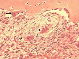 On radiography, the lesions exhibit bilateral multinuclear radiolucent areas. Typical Histopathology Of Cherubism A Histological Section From A Download Scientific Diagram