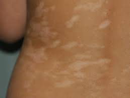 However, if it doesn't subside, it's better to consult your pediatrician or dermatologist especially if you notice the following signs: Pityriasis Alba Dermnet Nz