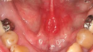 There may be more than one lump, as throat cancer may cause swelling in multiple lymph nodes on the neck. Self Oral Cancer Screening Socs Education Program School Of Dentistry Lsu Health New Orleans