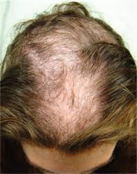 If you have a receding hairline or have noticed thinning hair on your… Hair Loss At A Very Young Age Clinician Reviews