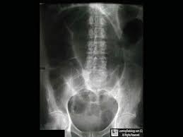 Inverted U Shape Appearance Of Distended Loop Of Sigmoid In Sigmoid Volvulus Coffee Bean Sign Radiologia