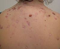 Find deals on products in beauty tools on amazon. Acne Wikipedia