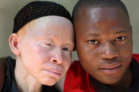It has been custom painted with a stark black and white design and finished with pearlescent highlights. Being Black In A White Skin Students With Albinism Battle Prejudice