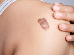 Banana works as a great conditioner for your clumped up oily hair. 5 Home Remedies To Get Rid Of Bumps After Waxing Nail Fungus Nail Fungus Treatment Homemade Hair Products