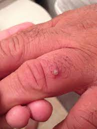 There are things you can do to treat and prevent them and ingrown hairs can look like raised, red, itchy spots on the skin. Ingrown Hair On Finger Infected Ingrown Hair