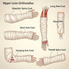 Image result for Long Arm Cast