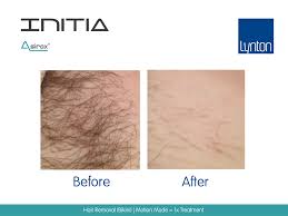 When i read that 90 percent of laser hair removal patients who are good candidates for the procedure report permanent hair. Professional Laser And Ipl Hair Removal Machines Lynton Lasers