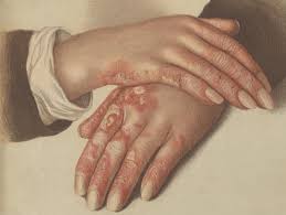 It can result in a number of symptoms, many of which can come and go over time. Discoid Lupus Symptoms Causes And Treatment