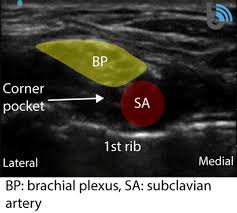 Image result for Superior Trunk Block