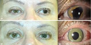 El Color De Los Ojos Se Puede Cambiar De Forma Permanente