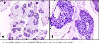 The kind of breast cancer depends on which cells in the breast turn into cancer. Mucinous Carcinoma Of The Breast A Case Report And Review Of The Literature Medwave