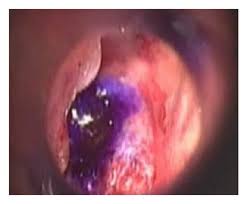 Image result for Myringosclerosis