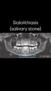 Image result for Sialolithiasis