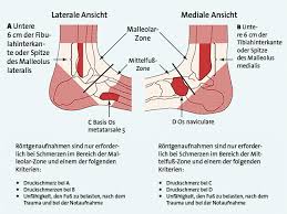 Stressfrakturen des malleolus medialis können schwer zu erkennen sein. Sprunggelenksdistorsion Wann Rontgen Wie Behandeln Doctors Today
