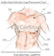 Holter Heart Monitor Lead Placement Chart