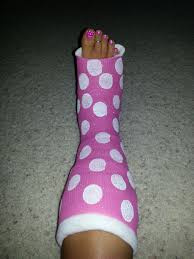How To Decorate Your Cast Spray Paint It Pink Then Add White Poka A Dots Super Cute Arm Cast Leg Cast It Cast