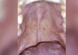 Umumnya ruam merah hiv dapat ditemukan pada bagian mulut, perut, ataupun kaki. Ruam Di Langit Langit Mulut Diduga Gejala Baru Covid 19 Republika Online