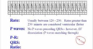 Ecg Ventricular Tachycardia Vt