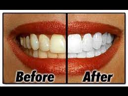 We did not find results for: How I Whiten My Teeth At Home Youtube