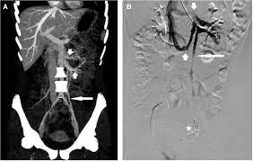Pelvic Congestion Syndrome Secondary To A Circumaortic Left Renal Vein The Journal Of Pediatrics