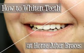 Food and other debris caught between your teeth can cause decay and discoloration. How To Whiten Teeth At Home After Braces