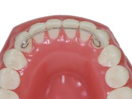 These retainers may cover the entire arch of the teeth or go from canine to canine. Retainers Orthodontic Center Of Oc