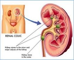 How To Get Rid Of Kidney Stones Fast And Naturally In 2020 Kidney Stones Remedy Kidney Stones Kidney Biopsy